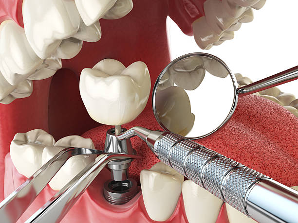 Best Broken or Chipped Tooth Repair in Baltimore, MD